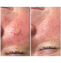 Urządzenie do liftingu PLAZone  Multi-Plasma Pen